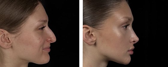 Ринопластика: до и после – фото 3